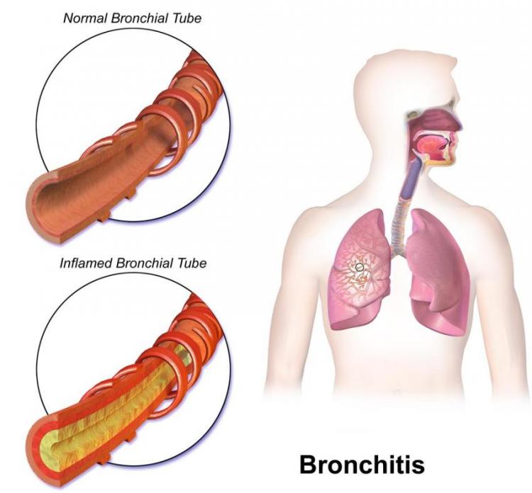 Gejala Penyakit Bronkitis