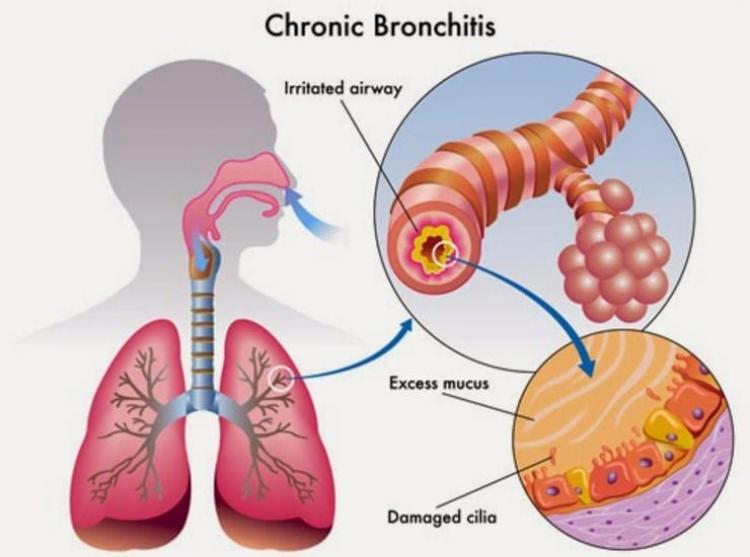 Jenis Pada Penyakit Bronkitis